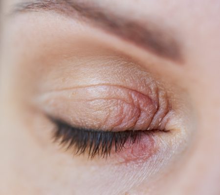 Demodekoza - nieprzyjemna choroba dermatologiczna.