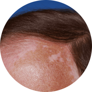 Pieczenie skóry głowy